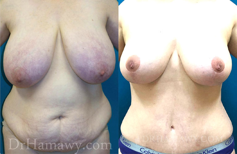 Case 1: Tummy Tuck, 360 Lipo and Breast Lift