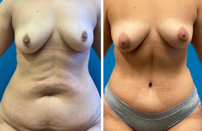 Case 2: Liposuction
