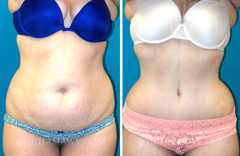Case 4: Tummy Tuck and 360 Lipo